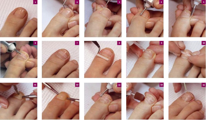 Ongle incarné. Causes d'apparition, symptômes, traitement sans chirurgie avec des remèdes populaires, pommades, chirurgie