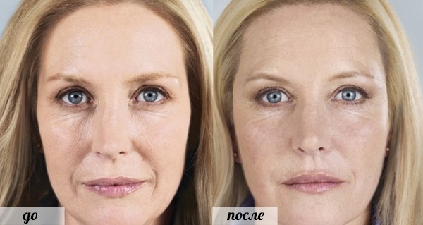 Comment supprimer les volées sur le visage, restaurer l'ovale: exercices, procédures en cosmétologie, gymnastique, levage