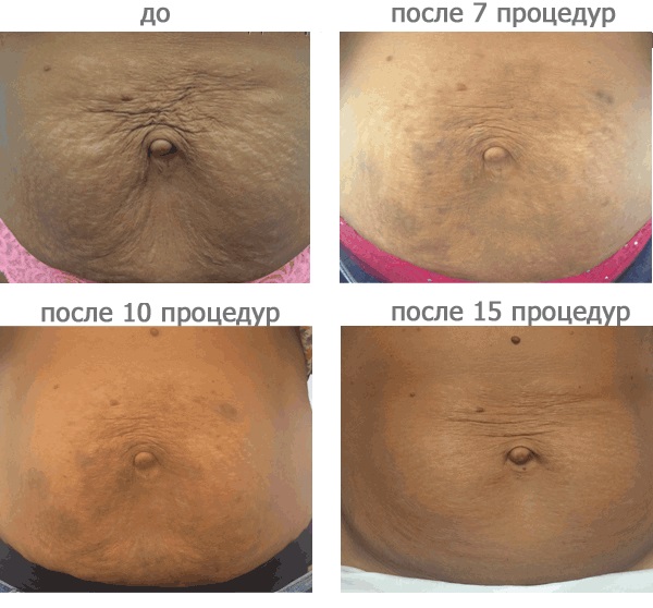 Carboxythérapie - qu'est-ce que c'est pour un visage en cosmétologie: non-injection, non-invasive, injection. Photos avant et après, prix, avis