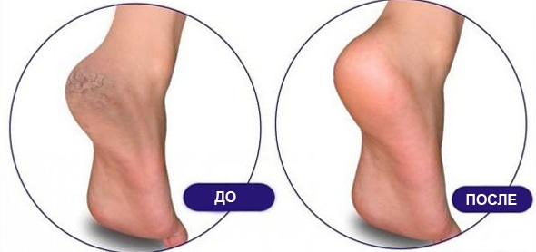 Crème de Zorka. Mode d'emploi pour les personnes aux talons fissurés, aux varices, au psoriasis, aux éperons de talon, à la dermatite, à l'eczéma, aux hémorroïdes