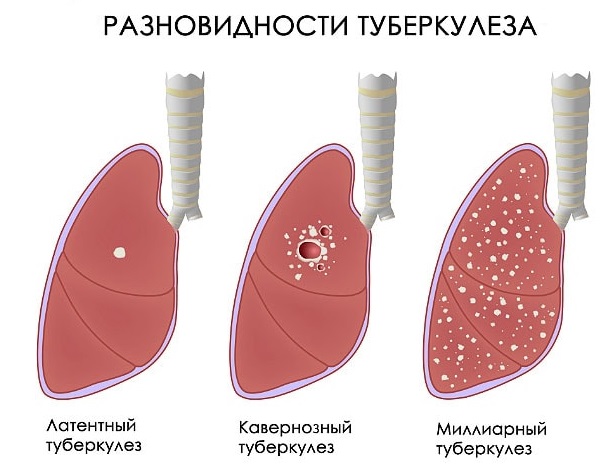Biorévitalisation au laser du visage avec de l'acide hyaluronique. Qu'est-ce que c'est, les critiques des cosmétologues. Prix pour 1 procédure, combien de procédures doivent être effectuées