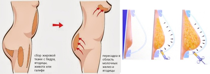 Opération de mammoplastie: réduction, augmentation, endoscopie laser, sans implants, masculinisation. Stades, rééducation et complications