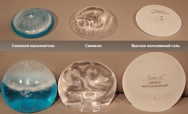 Opération de mammoplastie: réduction, augmentation, endoscopie laser, sans implants, masculinisation. Stades, rééducation et complications