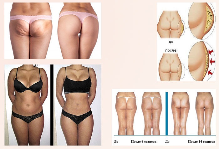 Pressotherapy - มันคืออะไรข้อบ่งชี้ข้อห้ามอุปกรณ์สำหรับการกดที่บ้าน ความคิดเห็นก่อนและหลังภาพถ่าย