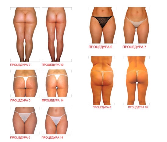 Pressotherapy - มันคืออะไรข้อบ่งชี้ข้อห้ามอุปกรณ์สำหรับการกดที่บ้าน ความคิดเห็นก่อนและหลังภาพถ่าย