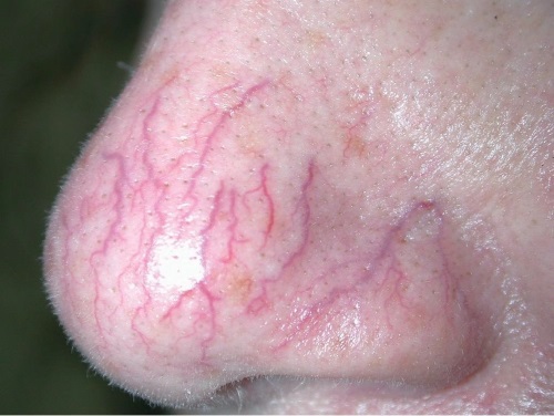 Microdermabrasion au diamant du visage - qu'est-ce que c'est, appareils, crèmes pour micropeeling enzymatique. Prix de la procédure