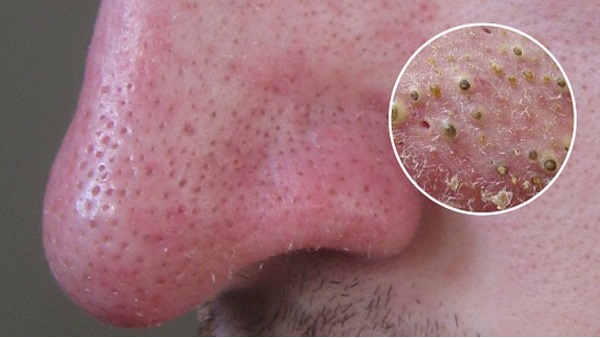 Argile noire pour le visage, les cheveux, la peau du corps. Propriétés et application: masques pour l'acné, les points noirs, la cellulite, le nettoyage, les enveloppements minceur