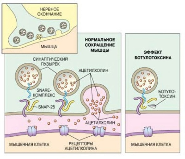 Ce qu'il ne faut pas faire après le botox. Combien de temps vous ne pouvez pas aller au lit, vous pencher, boire de l'alcool, des antibiotiques, faire du sport, prendre un bain de soleil, aller aux bains publics, à la piscine