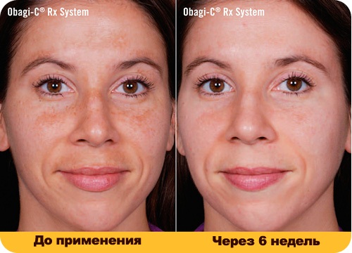 Qu'est-ce que l'hydroquinone, application en cosmétologie: crèmes blanchissantes, peeling, pommade, comprimés. Achroactive Max, avis