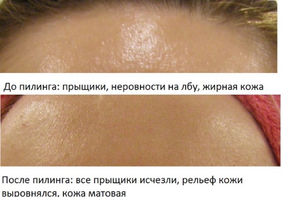 Peeling visage gaz-liquide. De quoi s'agit-il, indications, contre-indications. Application pour la grossesse, l'acné, la rosacée. Photos avant et après, avis