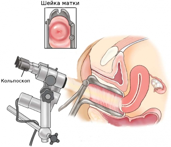 Comment se débarrasser des papillomes sur le corps avec du folk, des médicaments, des méthodes chirurgicales