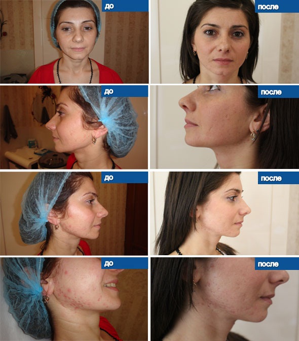 Mésoxanthine dans les procédures de bio-revitalisation. Efficacité de l'application, avis des cosmétologues, instructions sur la façon de piquer. Prix des médicaments