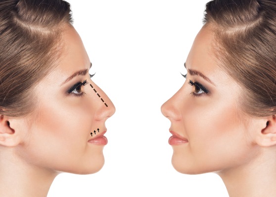 Chirurgie plastique du nez. Types, prix: correction du septum, réduction du nez, suppression de la bosse, remodelage, rhinoplastie de contour