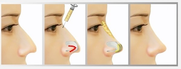 Chirurgie plastique du nez. Types, prix: correction du septum, réduction du nez, suppression de la bosse, remodelage, rhinoplastie de contour