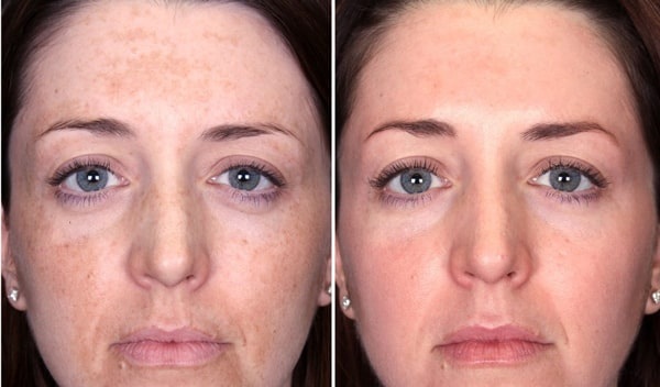 L'acné sur le menton chez les femmes sur le visage. Causes d'apparition après 30 ans, pendant la grossesse. Quel organe est en panne, remèdes maison