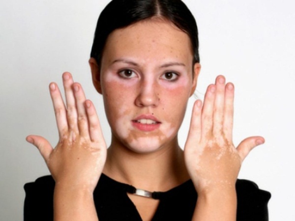 L'acné sur le menton chez les femmes sur le visage. Causes d'apparition après 30 ans, pendant la grossesse. Quel organe est en panne, remèdes maison