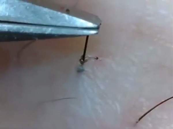 Poils incarnés dans la zone du bikini: comment s'en débarrasser à la maison. Comment enlever si enflammé, est devenu une bosse, après l'épilation, le shugaring