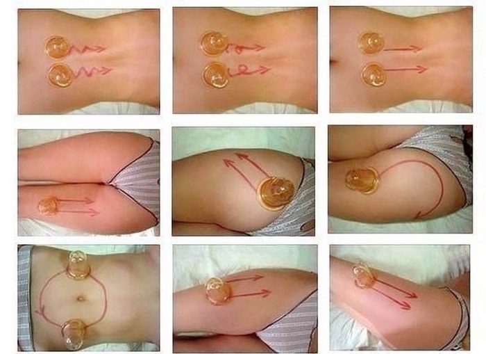 Cellulite sur les jambes et le bas.Comment se débarrasser des cuisses, des fesses: massage sous vide avec des canettes, enveloppements, produits, masseurs, exercices