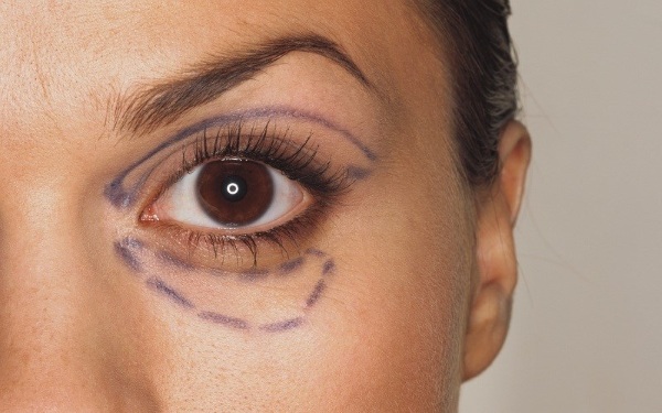 Blépharoplastie à Moscou. Prix en 2020, évaluation des cliniques, comment choisir un chirurgien, promotions, réductions