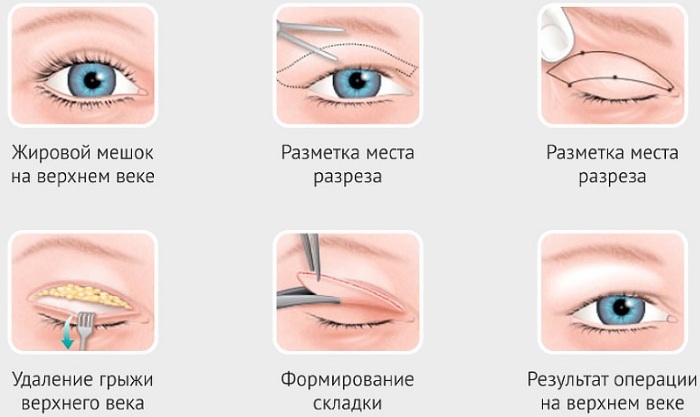 Blépharoplastie à Moscou. Prix en 2020, évaluation des cliniques, comment choisir un chirurgien, promotions, réductions