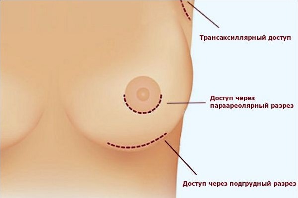 Augmentation mammaire. Coût à Moscou, Saint-Pétersbourg. Types d'implants, prix