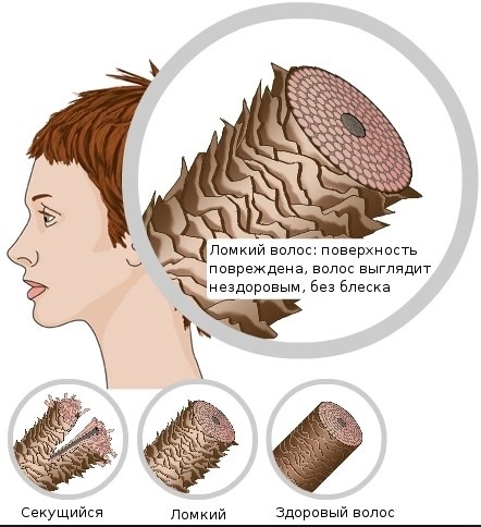 Vitamines en ampoules pour cheveux, nicotinique, acide ascorbique, dixon, kérastase. Masques à la maison