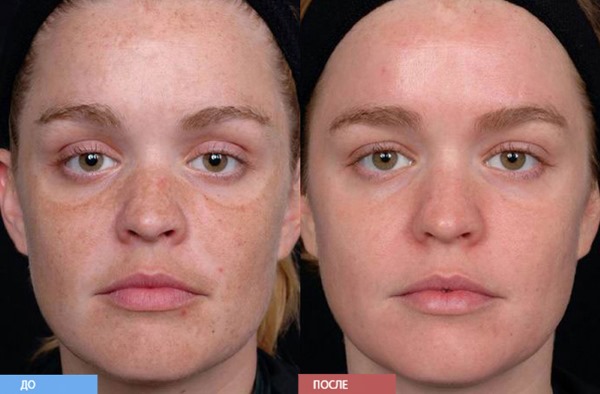 La dermabrasion du visage est au diamant, mécanique, laser. Qu'est-ce que c'est, les appareils, comment le faire à la maison