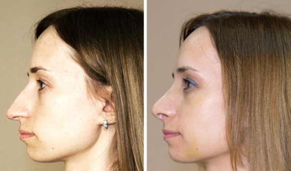 Rhinoplastie à Moscou. Prix et avis des cliniques dans la capitale