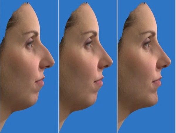 Rhinoplastie à Moscou. Prix et avis des cliniques dans la capitale