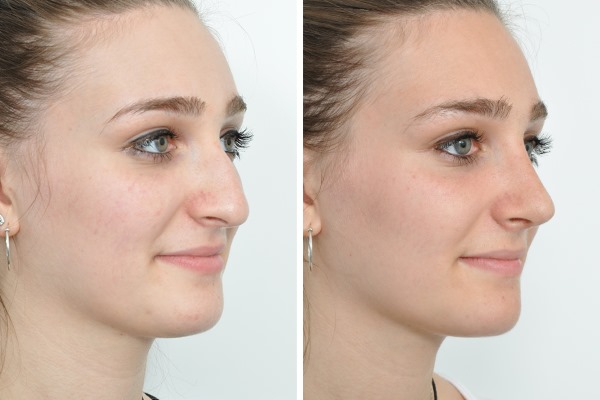 Rhinoplastie à Moscou. Prix et avis des cliniques dans la capitale