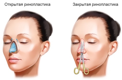 Rhinoplastie à Moscou. Prix et avis des cliniques dans la capitale