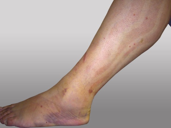 Bande Kinesio. Qu'est-ce que c'est en cosmétologie, médecine, sport.Rubans, esthétique, drainage lymphatique des rides, des plis nasogéniens