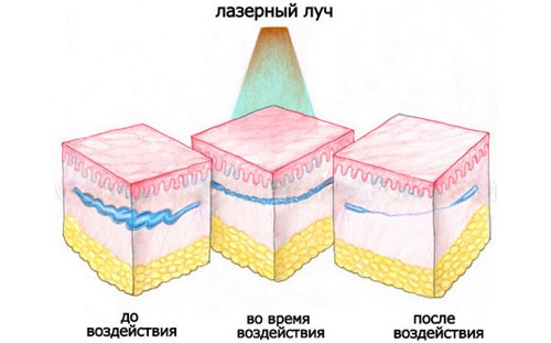 Élimination au laser des vaisseaux sanguins sur le visage avec un laser au néodyme, flash, elos. photos avant et après, avis