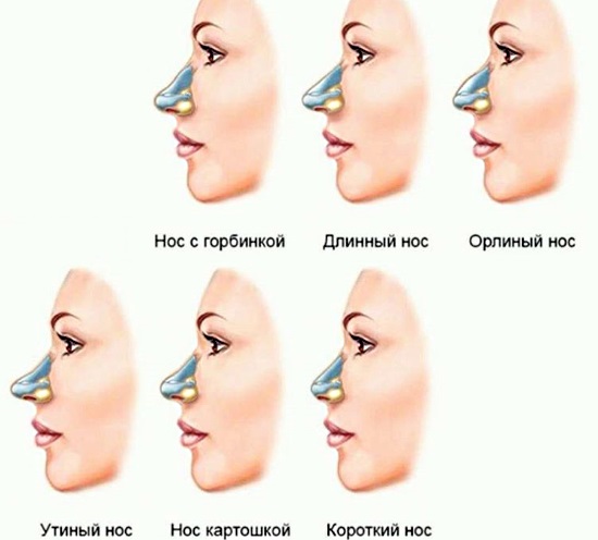 Comment réparer le nez d'une femme avec des pommes de terre. Rhinoplastie, photo avant et après chirurgie, prix