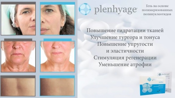 Polynucléotides en cosmétologie par injection. Préparations, prix, où acheter