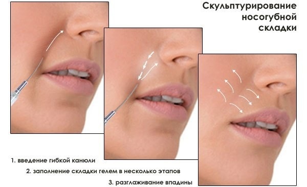 Radiesse en cosmétologie. Avis des cosmétologues, contre-indications, conséquences