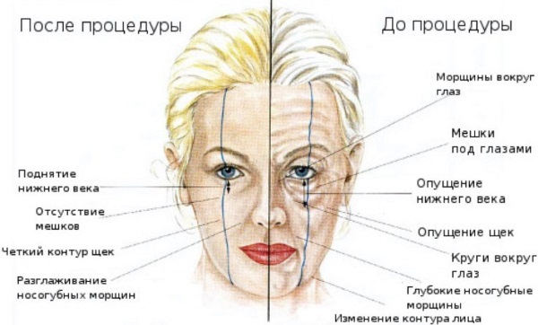 Radiesse en cosmétologie. Avis des cosmétologues, contre-indications, conséquences