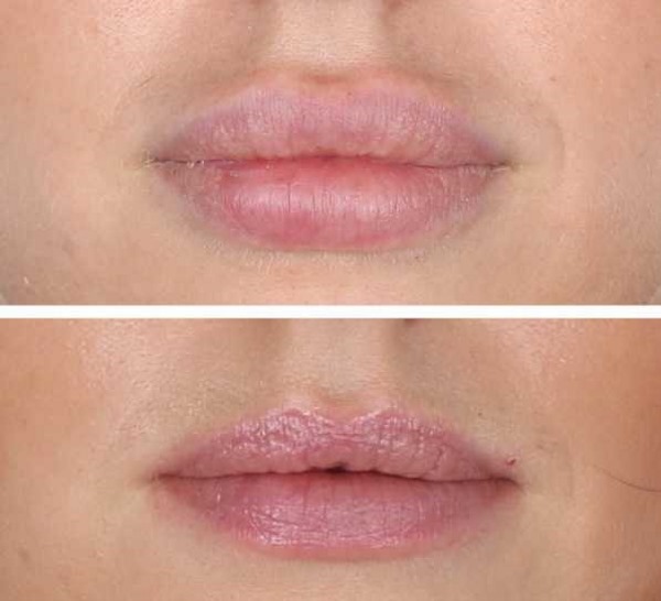 Effet Tyndall en cosmétologie sous les yeux, sur la peau des lèvres. Lorsqu'on observe comment supprimer