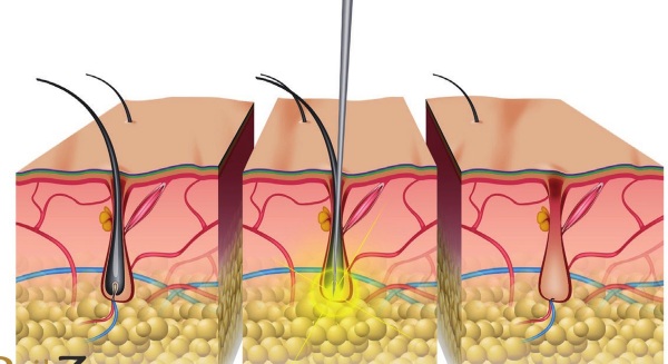 Épilation dans la zone profonde du bikini. Sucre, épilation au laser, épilation à la cire, photoépilation, électrolyse, bioépilation