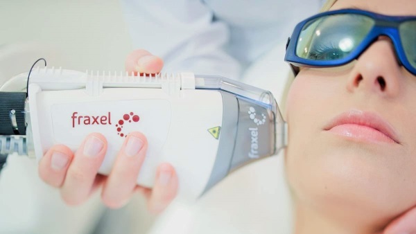 Élimination des capillaires sur le visage avec un laser. Comment se déroule la procédure, contre-indications, conséquences, prix, avis