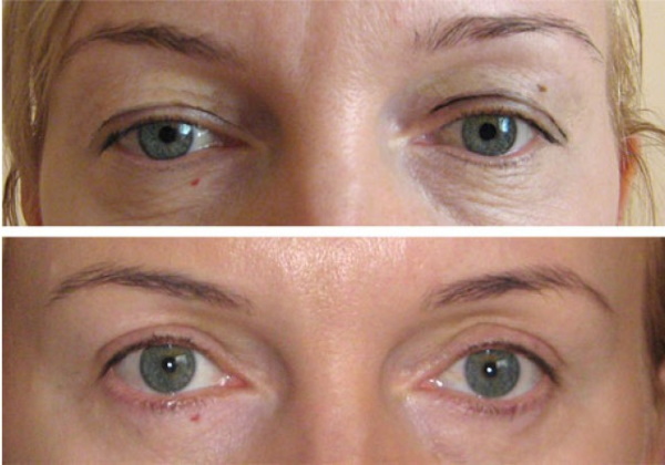 Lifting des paupières chirurgical et non chirurgical. Blépharoplastie circulaire, mésothreads, laser, botox. Photos, prix
