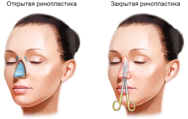 Rhinoplastie du nez: fermé, ouvert, reconstructif, injection, laser. Prix et avis