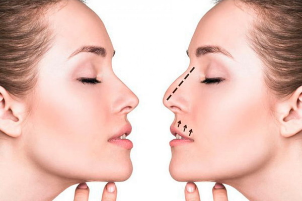 Rhinoplastie du nez: fermé, ouvert, reconstructif, injection, laser. Prix et avis