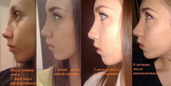 Rhinoplastie du nez: fermé, ouvert, reconstructif, injection, laser. Prix et avis