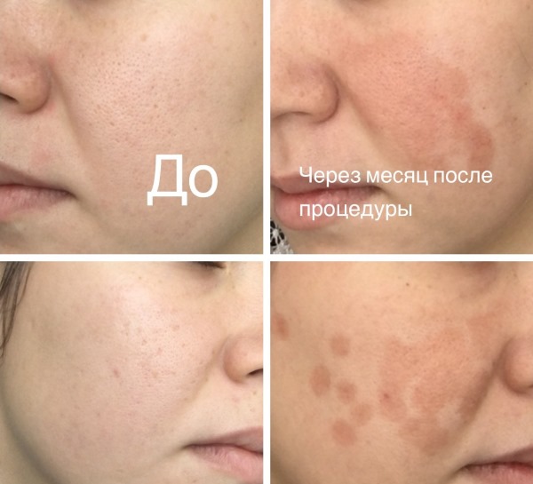 Nettoyage de la peau du visage au laser. Prix de blanchiment, rajeunissement, contre-indications