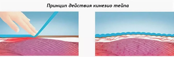 Ruban anti-rides des sourcils. Schéma, photo avant et après