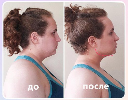 Comment supprimer un double menton.Cosmétologie sans chirurgie: injections, fils, charges, exercices, revitonics, lifting RF, lipolytiques, Darsonval, teips et plus