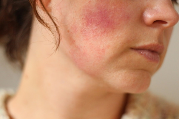 Comment supprimer un double menton. Cosmétologie sans chirurgie: injections, fils, charges, exercices, revitonics, lifting RF, lipolytiques, Darsonval, teips et plus