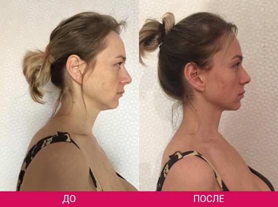 Comment supprimer un double menton. Cosmétologie sans chirurgie: injections, fils, charges, exercices, revitonics, lifting RF, lipolytiques, Darsonval, teips et plus