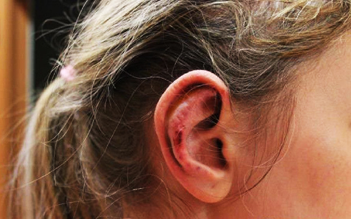 Chirurgie de l'oreille pour les oreilles tombantes. Quel est le prix